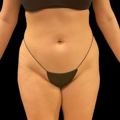 Brazilian Butt Lift Before & After Patient #9108