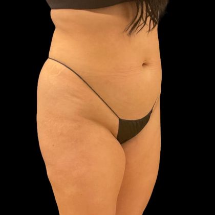 Brazilian Butt Lift Before & After Patient #9108