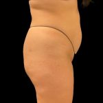 Brazilian Butt Lift Before & After Patient #9108