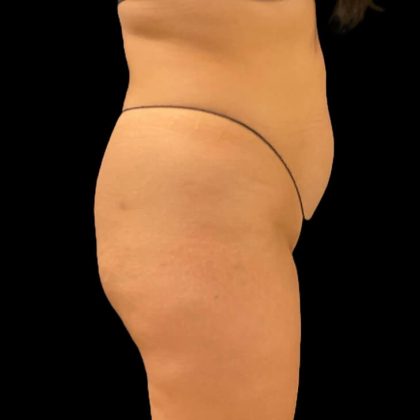 Brazilian Butt Lift Before & After Patient #9108