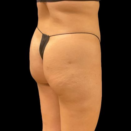 Brazilian Butt Lift Before & After Patient #9108