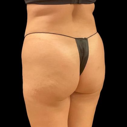Brazilian Butt Lift Before & After Patient #9108