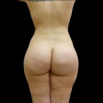 Brazilian Butt Lift Before & After Patient #9204