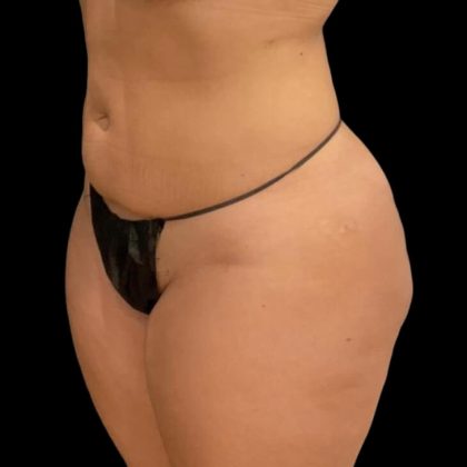 Brazilian Butt Lift Before & After Patient #6039