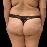 Brazilian Butt Lift Before & After Patient #6039