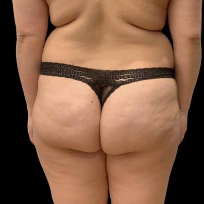 Brazilian Butt Lift Before & After Patient #6039