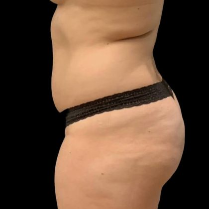 Brazilian Butt Lift Before & After Patient #6039