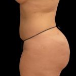 Brazilian Butt Lift Before & After Patient #6039
