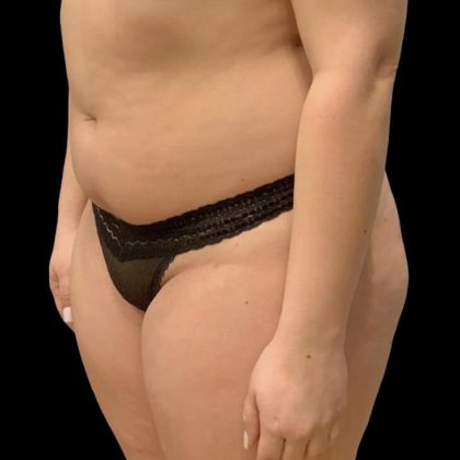 Brazilian Butt Lift Before & After Patient #6039