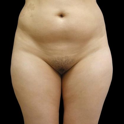 Brazilian Butt Lift Before & After Patient #6197