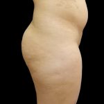 Brazilian Butt Lift Before & After Patient #6197