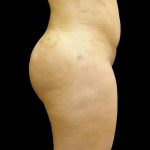 Brazilian Butt Lift Before & After Patient #6197