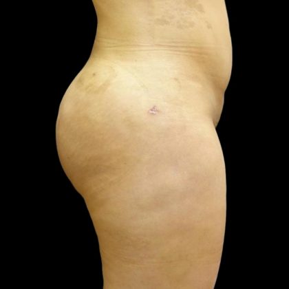 Brazilian Butt Lift Before & After Patient #6197