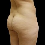 Brazilian Butt Lift Before & After Patient #6197