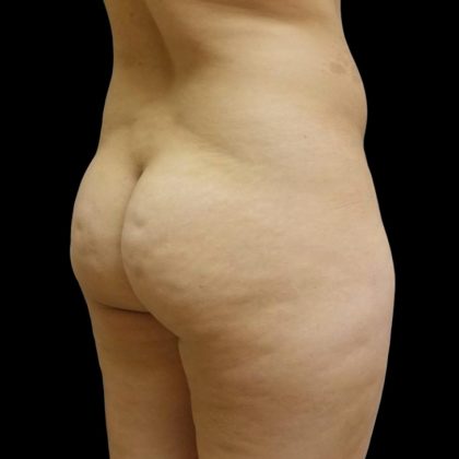 Brazilian Butt Lift Before & After Patient #6197