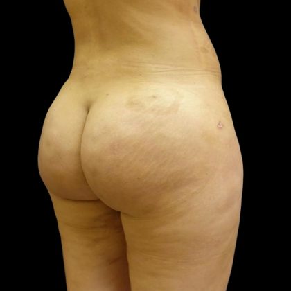 Brazilian Butt Lift Before & After Patient #6197