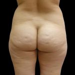 Brazilian Butt Lift Before & After Patient #6197