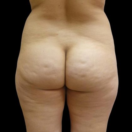 Brazilian Butt Lift Before & After Patient #6197