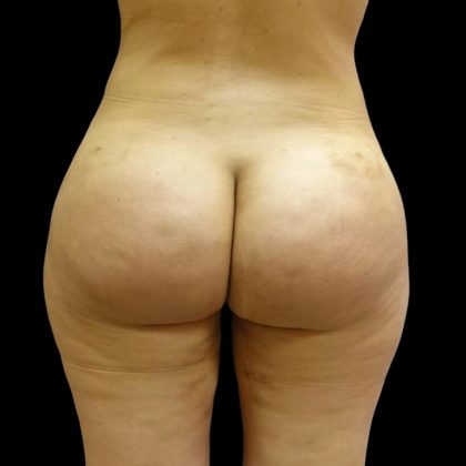 Brazilian Butt Lift Before & After Patient #6197