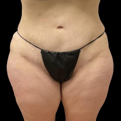Brazilian Butt Lift Before & After Patient #6250