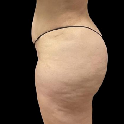 Brazilian Butt Lift Before & After Patient #6250