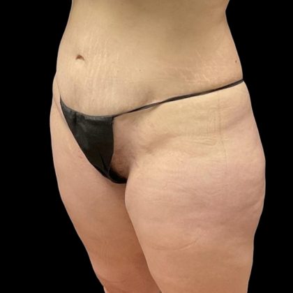 Brazilian Butt Lift Before & After Patient #6250
