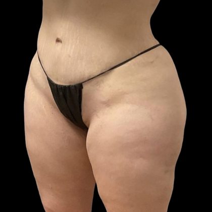 Brazilian Butt Lift Before & After Patient #6250
