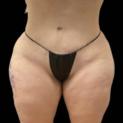 Brazilian Butt Lift Before & After Patient #6250