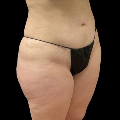 Brazilian Butt Lift Before & After Patient #6250