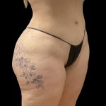 Brazilian Butt Lift Before & After Patient #6250