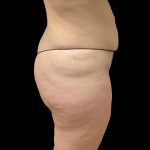 Brazilian Butt Lift Before & After Patient #6250