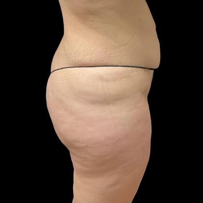 Brazilian Butt Lift Before & After Patient #6250