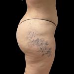 Brazilian Butt Lift Before & After Patient #6250