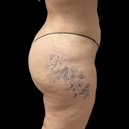 Brazilian Butt Lift Before & After Patient #6250