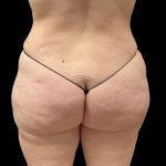 Brazilian Butt Lift Before & After Patient #6250