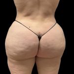 Brazilian Butt Lift Before & After Patient #6250