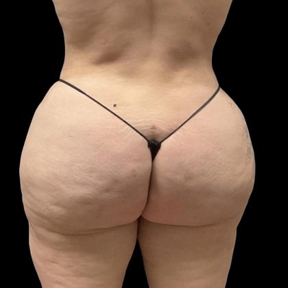 Brazilian Butt Lift Before & After Patient #6250