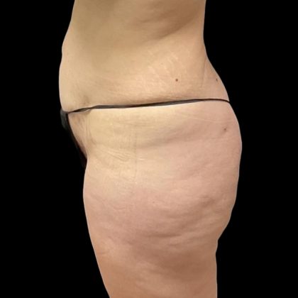 Brazilian Butt Lift Before & After Patient #6250