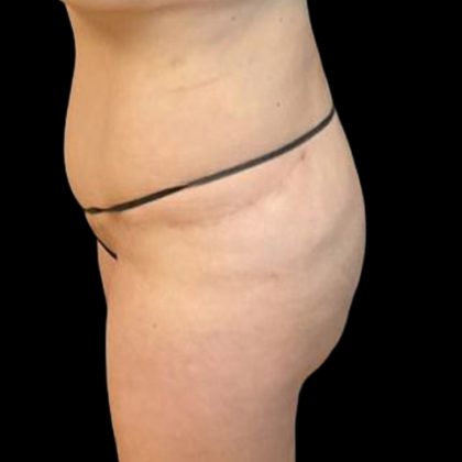 Brazilian Butt Lift Before & After Patient #8554