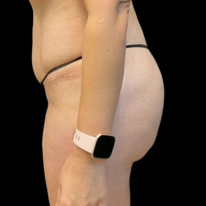 Brazilian Butt Lift Before & After Patient #8554