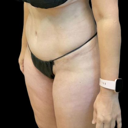 Brazilian Butt Lift Before & After Patient #8554