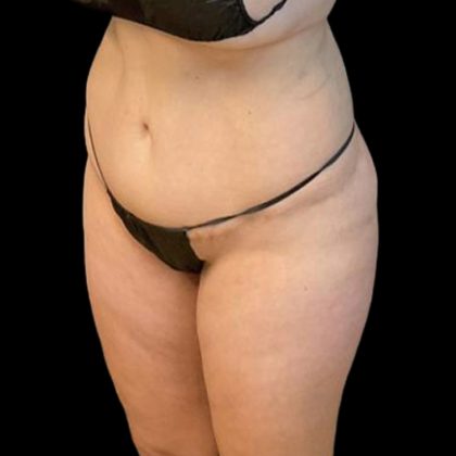 Brazilian Butt Lift Before & After Patient #8554