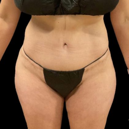 Brazilian Butt Lift Before & After Patient #8554