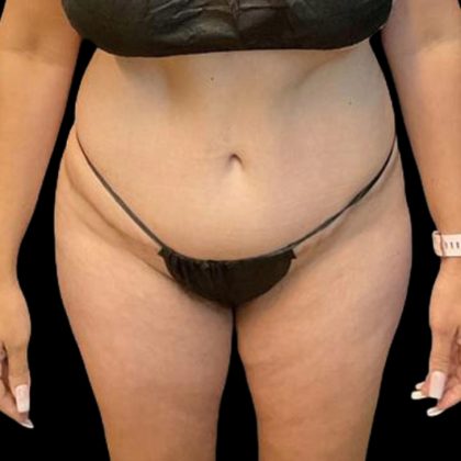 Brazilian Butt Lift Before & After Patient #8554