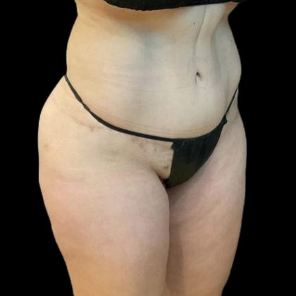 Brazilian Butt Lift Before & After Patient #8554