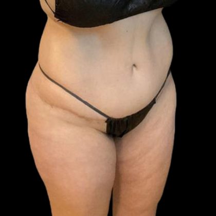 Brazilian Butt Lift Before & After Patient #8554