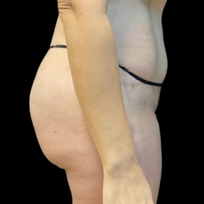 Brazilian Butt Lift Before & After Patient #8554