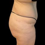 Brazilian Butt Lift Before & After Patient #8554