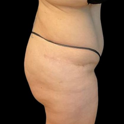 Brazilian Butt Lift Before & After Patient #8554