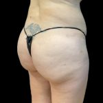 Brazilian Butt Lift Before & After Patient #8554